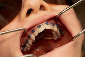 Palate Expander Upper Jaw with Braces