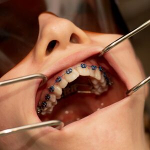 Palate Expander Upper Jaw with Braces