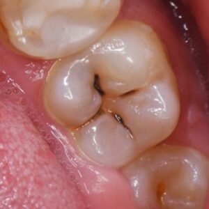 Cavities - Developing