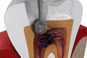 Drilling a Cavity