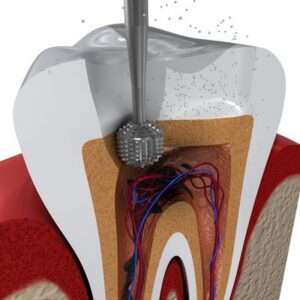 Drilling a Cavity