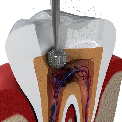 Drilling a Cavity