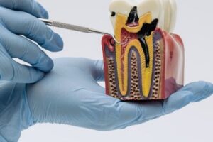 Dental Cavity Devleopment - Illustrating on Cutaway