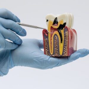 Cavities - Illustrating on Cutaway Dental Cavity Devleopment - Illustrating on Cutaway