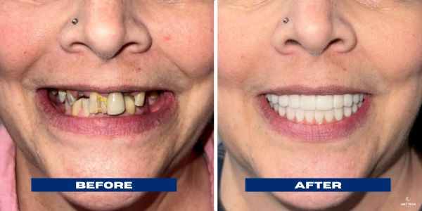 Jennifer- All On 4 BA Smile Transformation