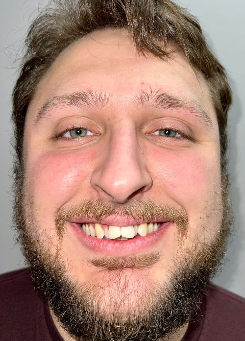 Ben Clear Invisible Aligners- Before Ben Clear Invisible Aligners- Before