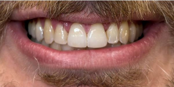 Ben Clear Invisible Aligners - Mouth - After