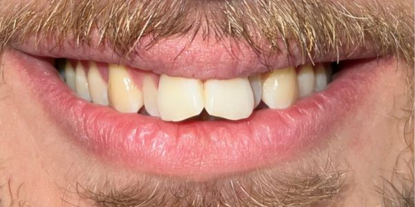 Ben Clear Invisible Aligners - Mouth - Before Ben Clear Invisible Aligners - Mouth - Before