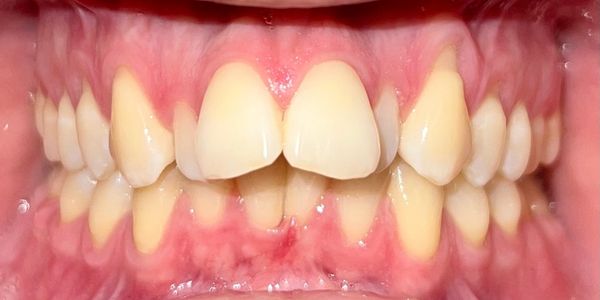 Ben Clear Invisible Aligners - Retracted - After