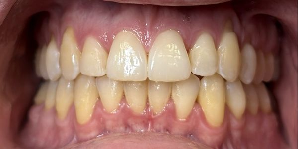 Ben Clear Invisible Aligners - Retracted - Before Ben Clear Invisible Aligners - Retracted - Before