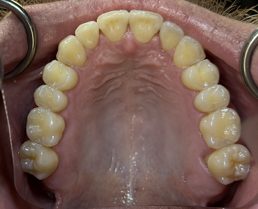 Ben - Invisible Clear Aligners Upper - After
