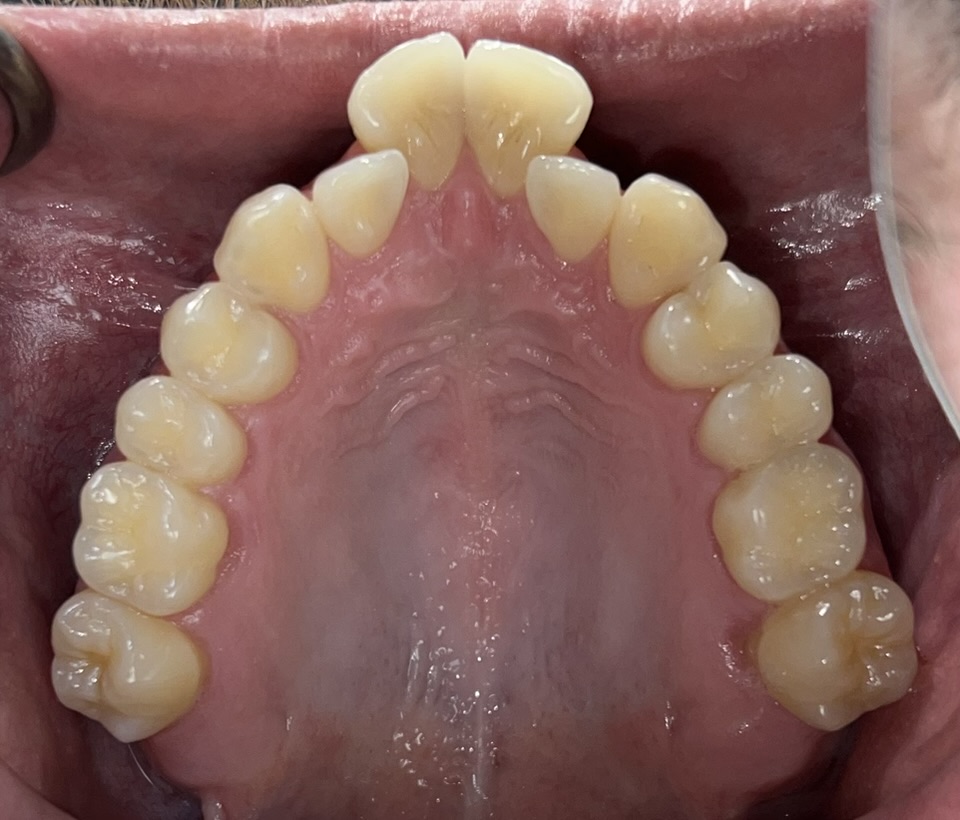 Ben - Invisible Clear Aligners Upper - Before Ben - Invisible Clear Aligners Upper - Before