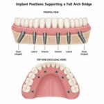 Full Arch Implants - Implant Positions