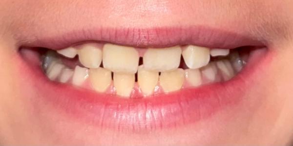 Jaxson-Palate-Expander - After - Mouth Jaxson Palate Expander - After - Mouth