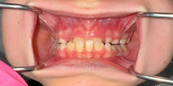 Jaxson-Palate-Expander - Retracted Before Jaxson Palate Expander Retracted Before
