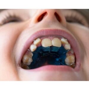 Palate Expander-Closeup