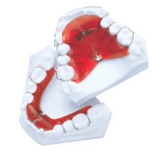 Palate Appliance