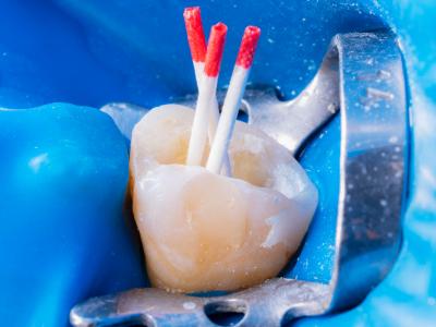 Root Canal - Procedure Example